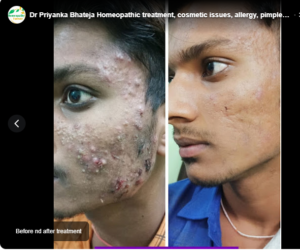 Dr Priyanka Bhateja Homeopathic treatment, cosmetic issues, allergy, pimples Hair fall,old scar,PCOD, Kidney Stone,Milia