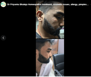 Dr Priyanka Bhateja Homeopathic treatment, cosmetic issues, allergy, pimples Hair fall,old scar,PCOD, Kidney Stone,Milia
