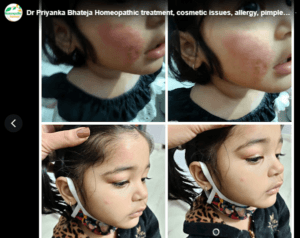 Dr Priyanka Bhateja Homeopathic treatment, cosmetic issues, allergy, pimples Hair fall,old scar,PCOD, Kidney Stone,Milia