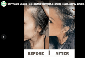 Dr Priyanka Bhateja Homeopathic treatment, cosmetic issues, allergy, pimples Hair fall,old scar,PCOD, Kidney Stone,Milia