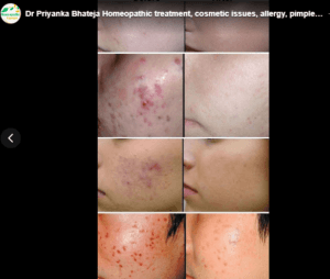 Dr Priyanka Bhateja Homeopathic treatment, cosmetic issues, allergy, pimples Hair fall,old scar,PCOD, Kidney Stone,Milia