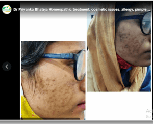 Dr Priyanka Bhateja Homeopathic treatment, cosmetic issues, allergy, pimples Hair fall,old scar,PCOD, Kidney Stone,Milia